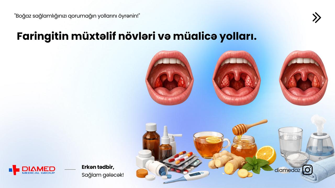 Faringitin növləri – Boğaz iltihabını düzgün tanıyın